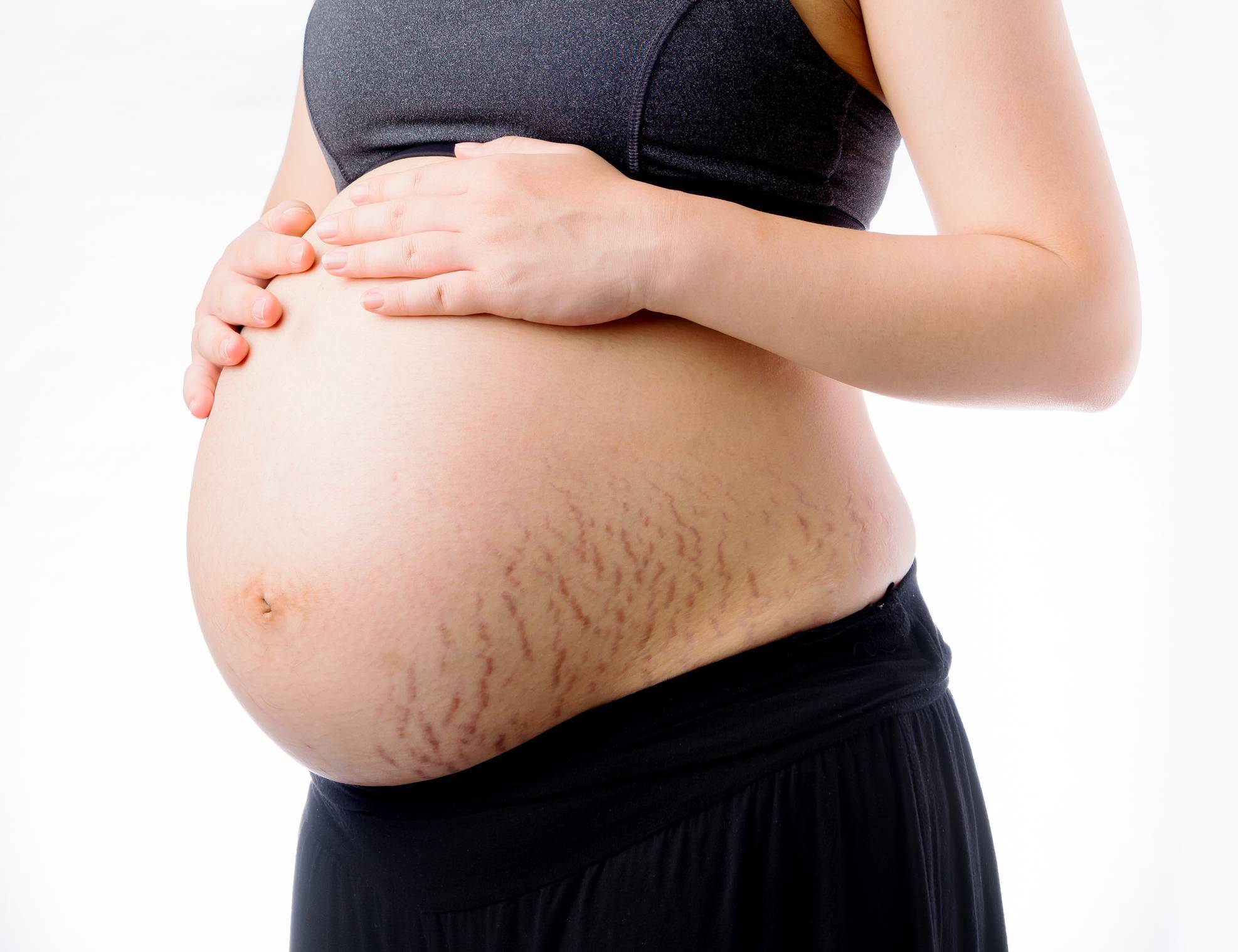vergetures grossesse stries sécheresse peau